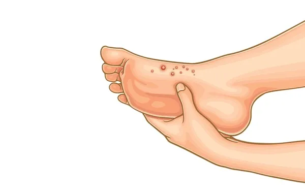 Blister