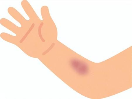 Bruise